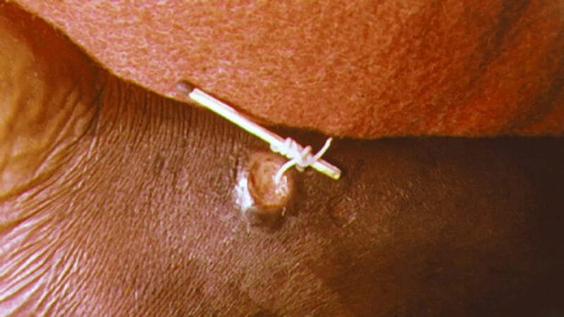 Photo of worm wrapped around matchstick coming out of leg